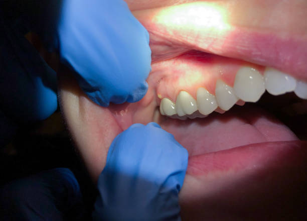 Best Broken or Cracked Tooth Emergency Dentist in Sparta, MO
